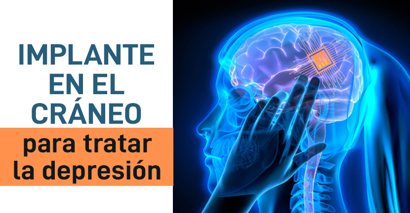Implante en el cráneo para tratar la depresión