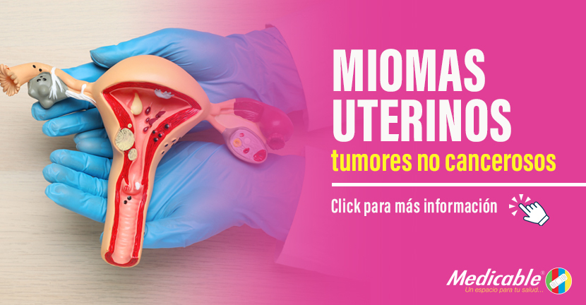 Miomas Uterinos
