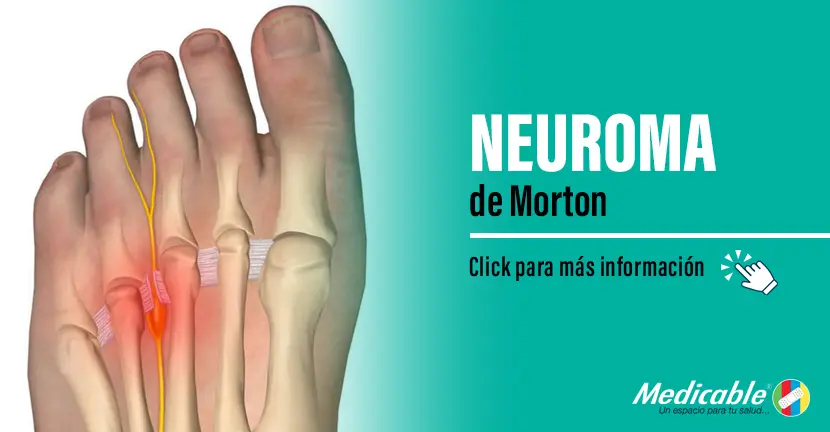 Neuroma de Morton.