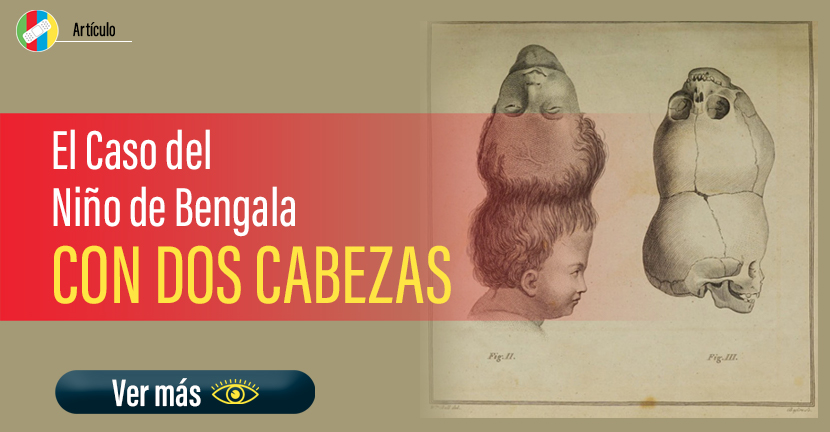El Caso del Niño de Bengala con Dos Cabezas.