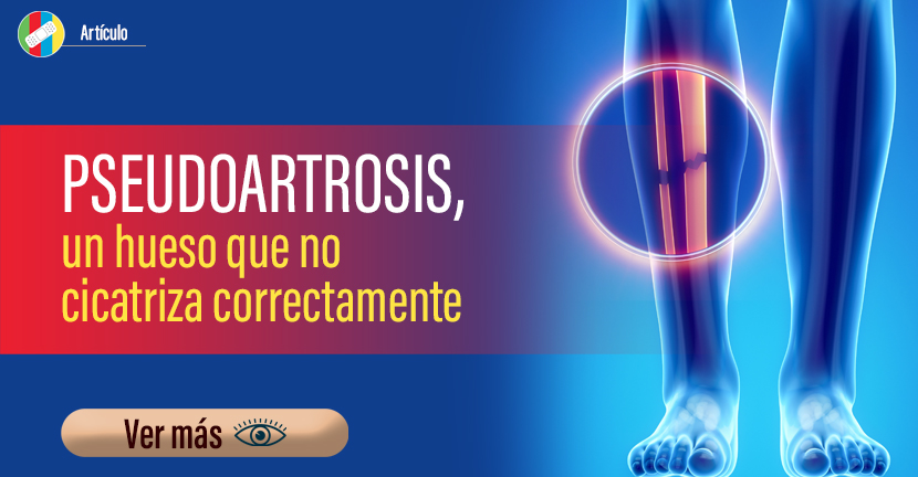 Pseudoartrosis, un hueso que no cicatriza correctamente.