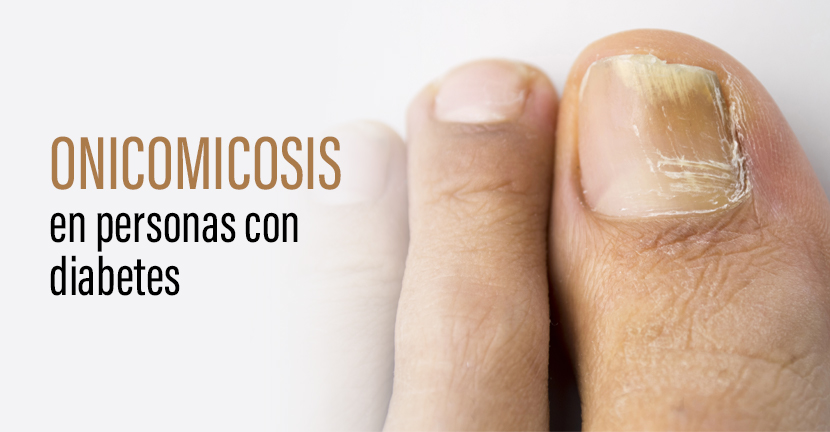Onicomicosis en personas con diabetes