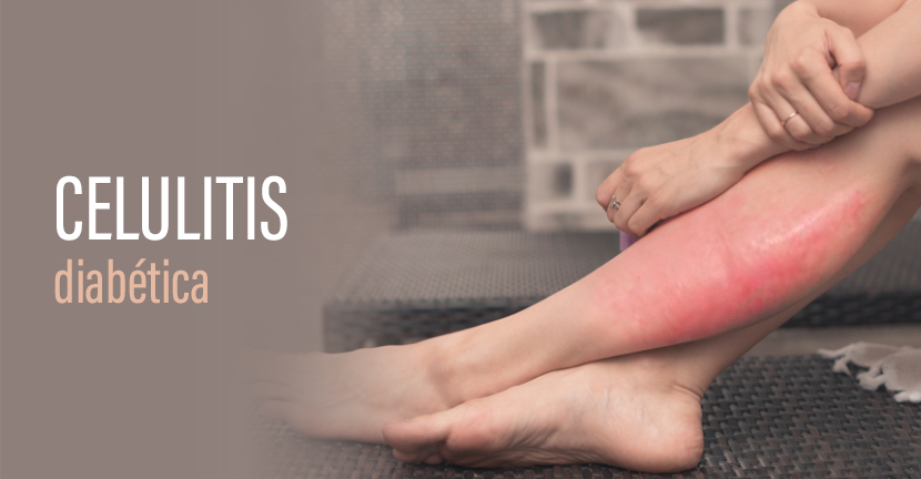 Celulitis diabética