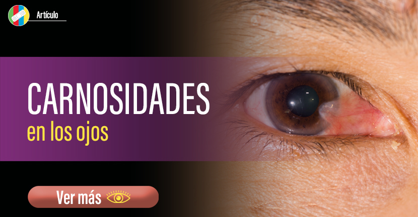 Carnosidades en los ojos