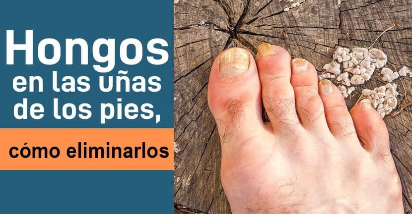 Hongos en las uñas de los pies, cómo eliminarlos