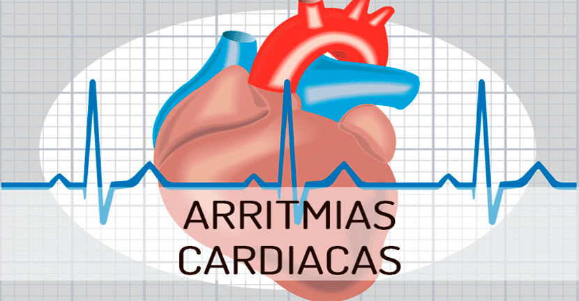 Arritmias cardiacas