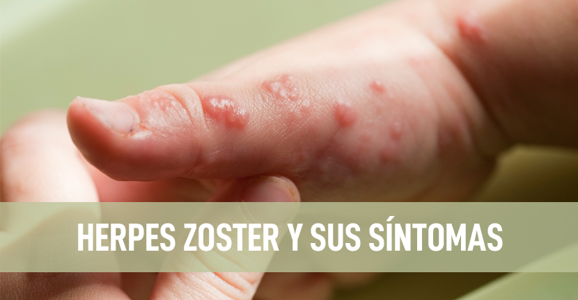 Herpes Zoster y sus síntomas