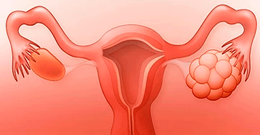Mujeres con síndrome de ovario poliquístico propensas a desarrollar diabetes