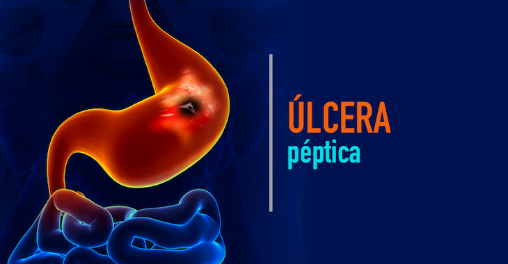 Úlcera péptica