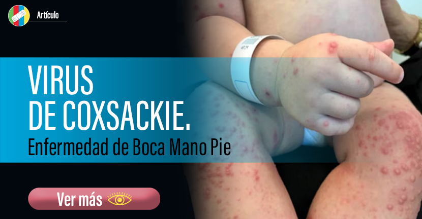 Virus de Coxsackie. Enfermedad de Boca Mano Pie.