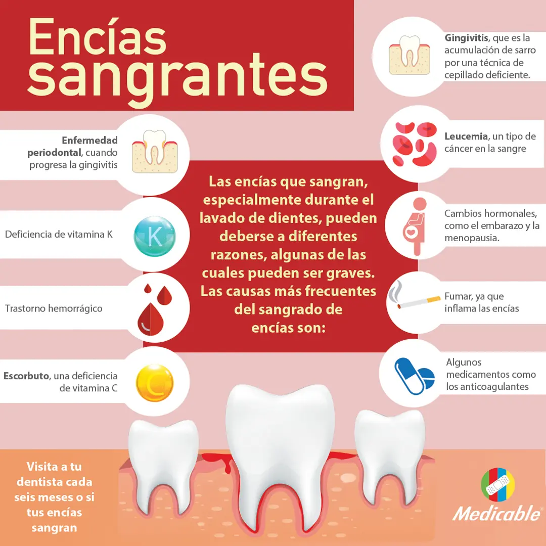 Encías Sangrantes