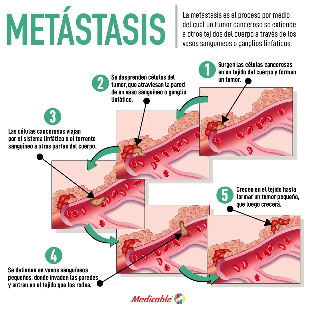 Metastasis