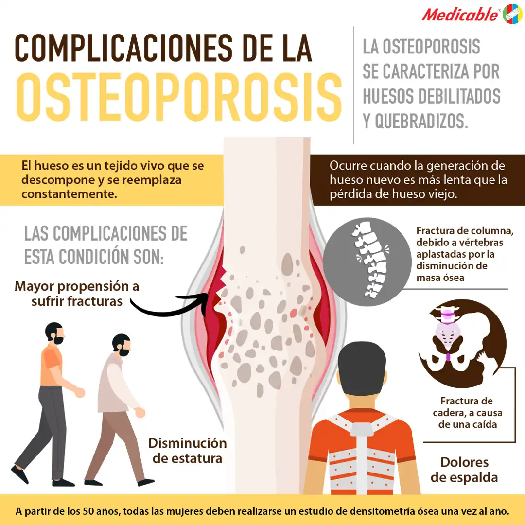 Complicaciones de la osteoporosis