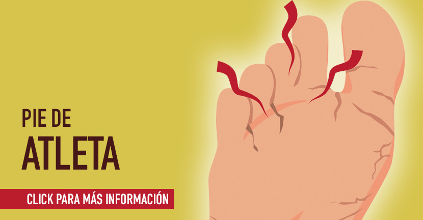 Pie de atleta