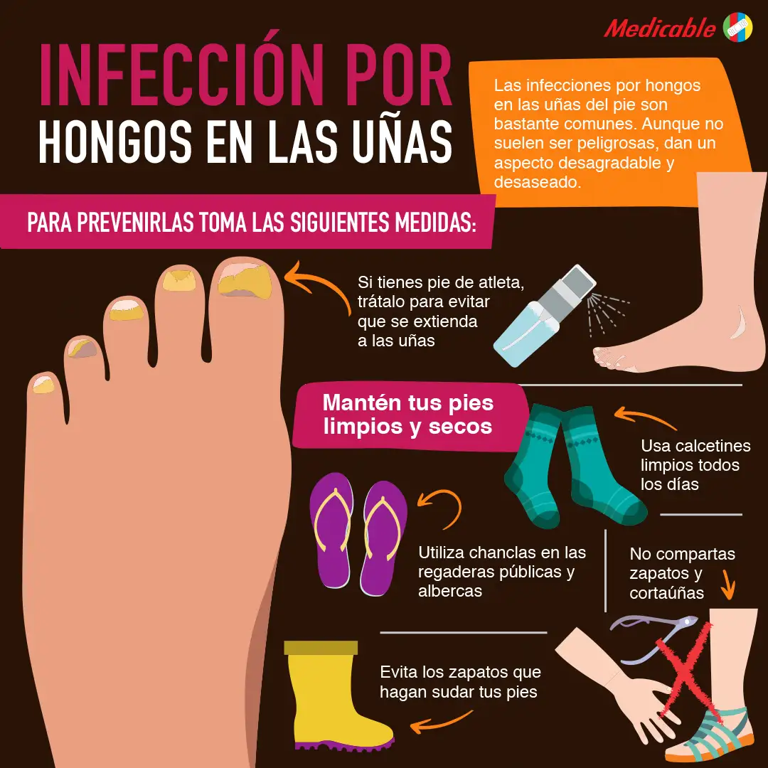 Hongos en las uñas de los pies