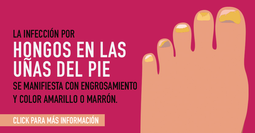 Hongos en las uñas de los pies