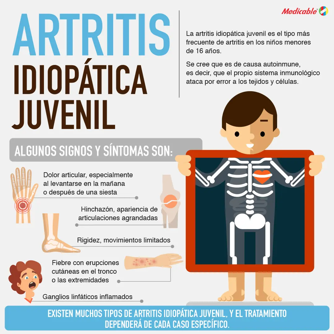 Artritis ideopática juvenil 