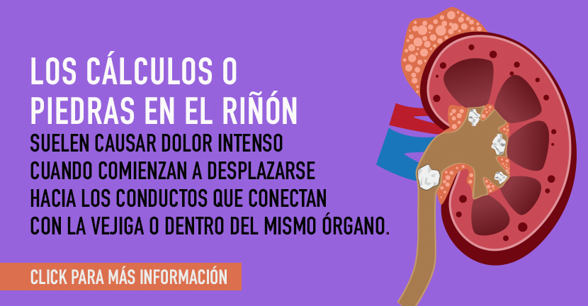 Cálculos renales