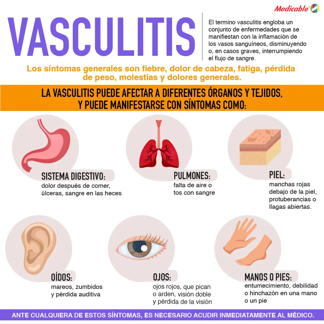 Vasculitis