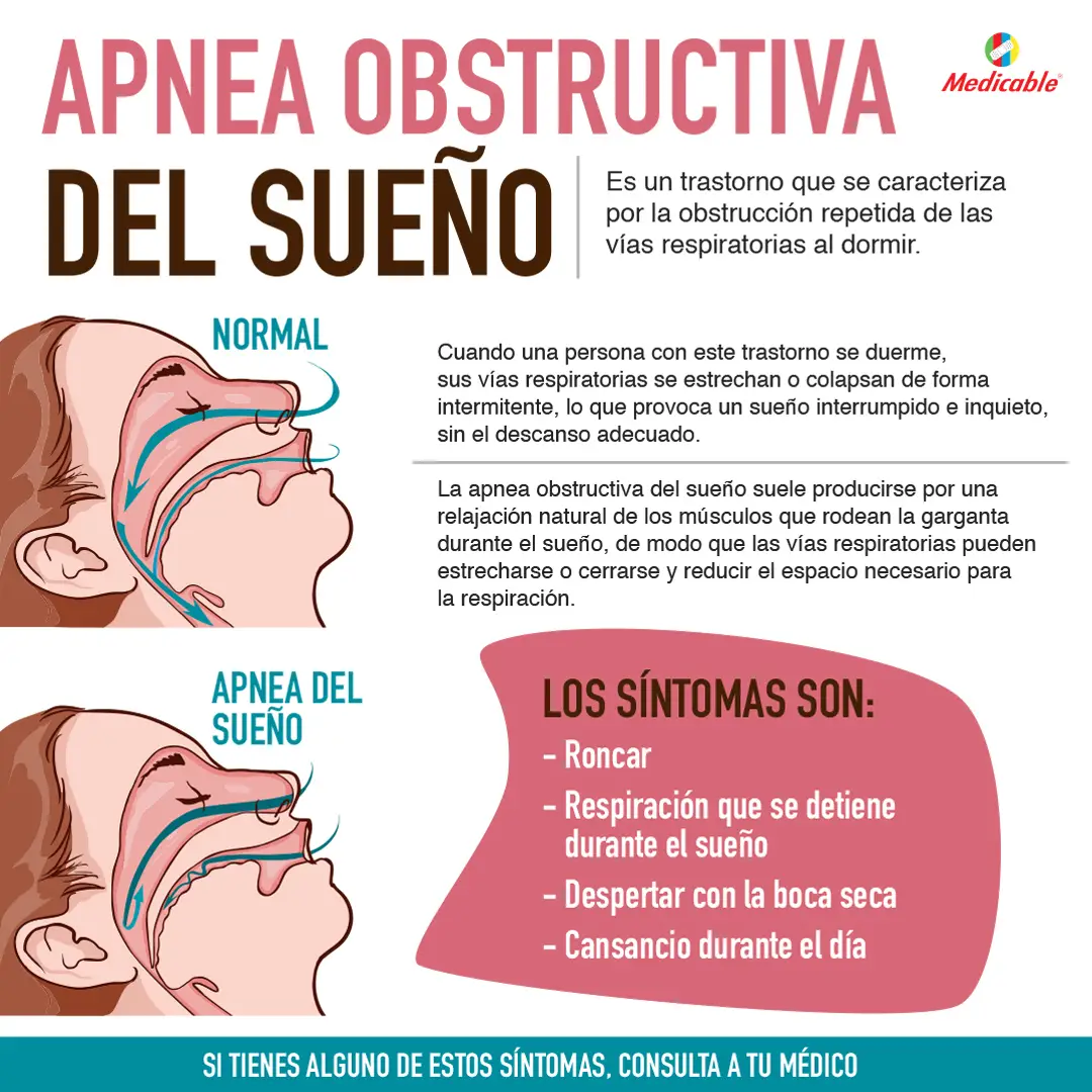 Apnea obstructiva del sueño