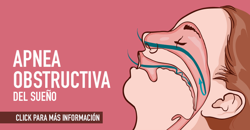 Apnea obstructiva del sueño