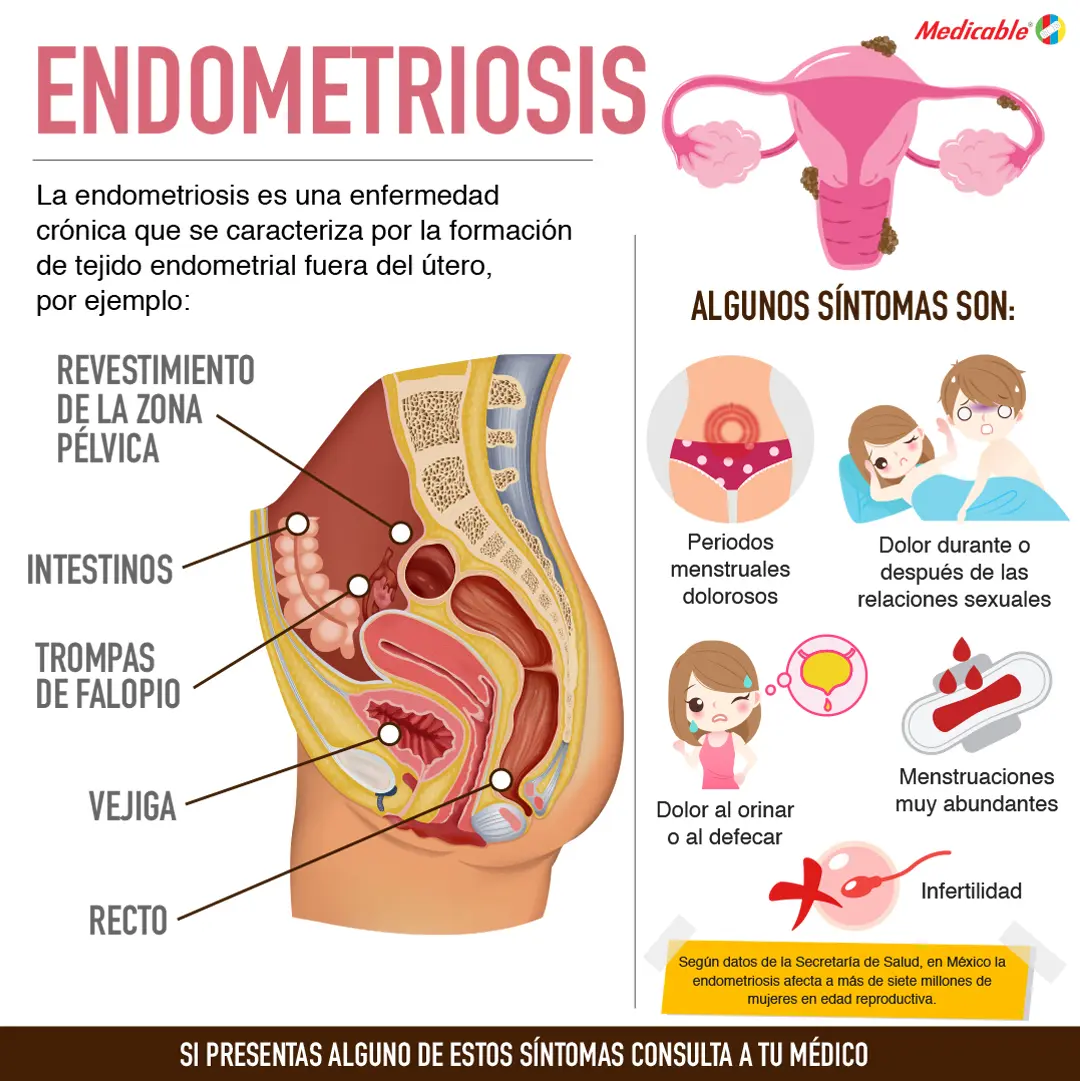 Endometriosis