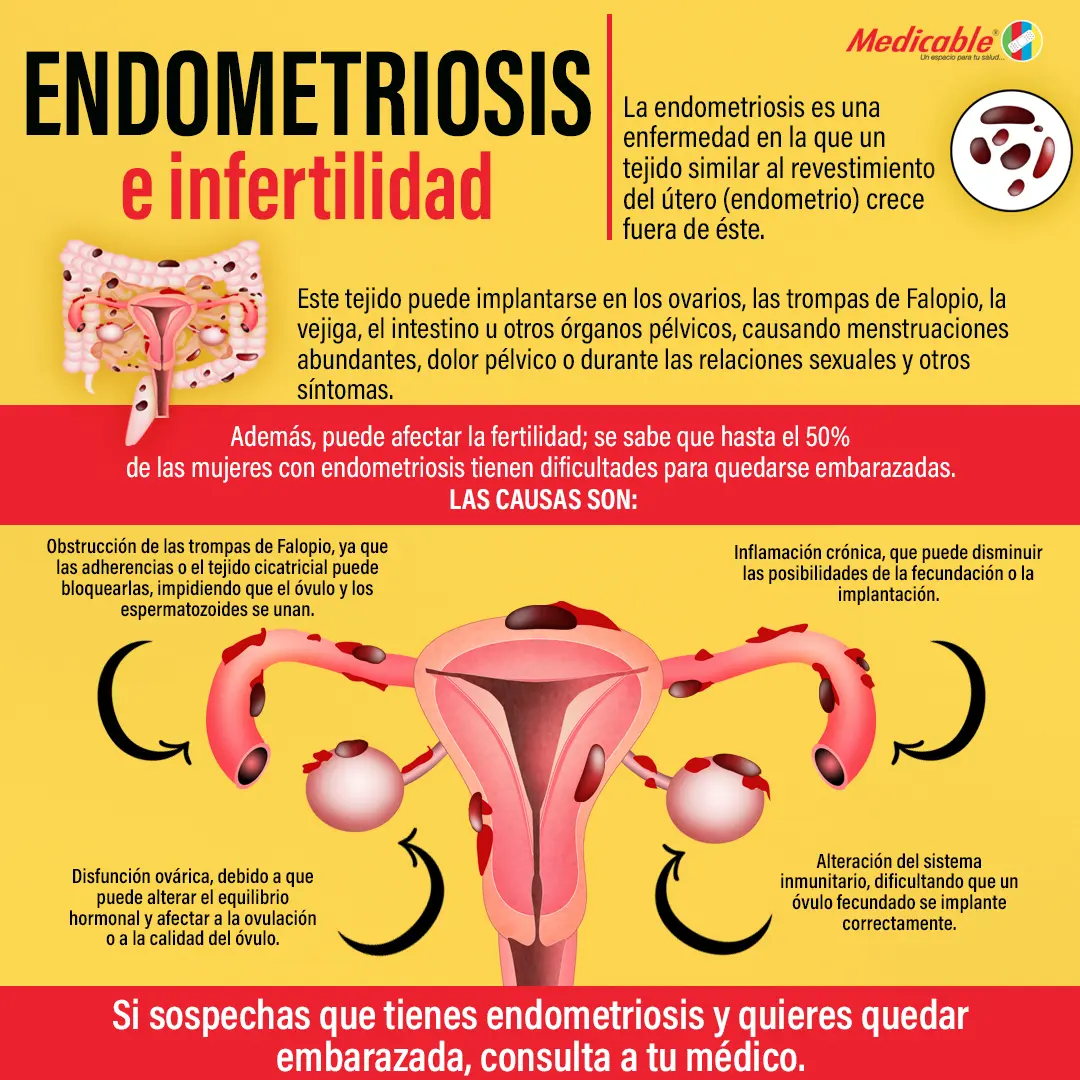 Endometriosis e infertilidad