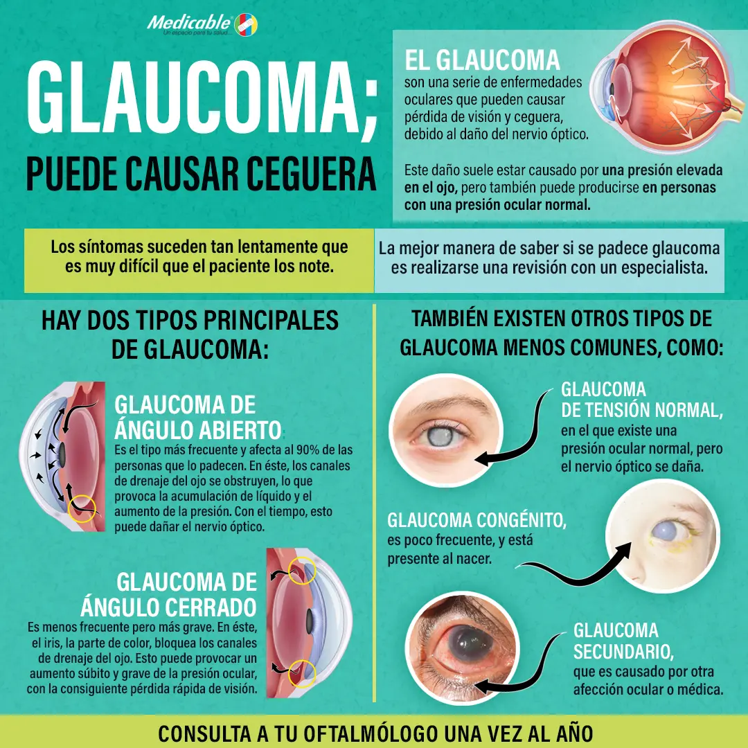 Glaucoma, puede causar ceguera