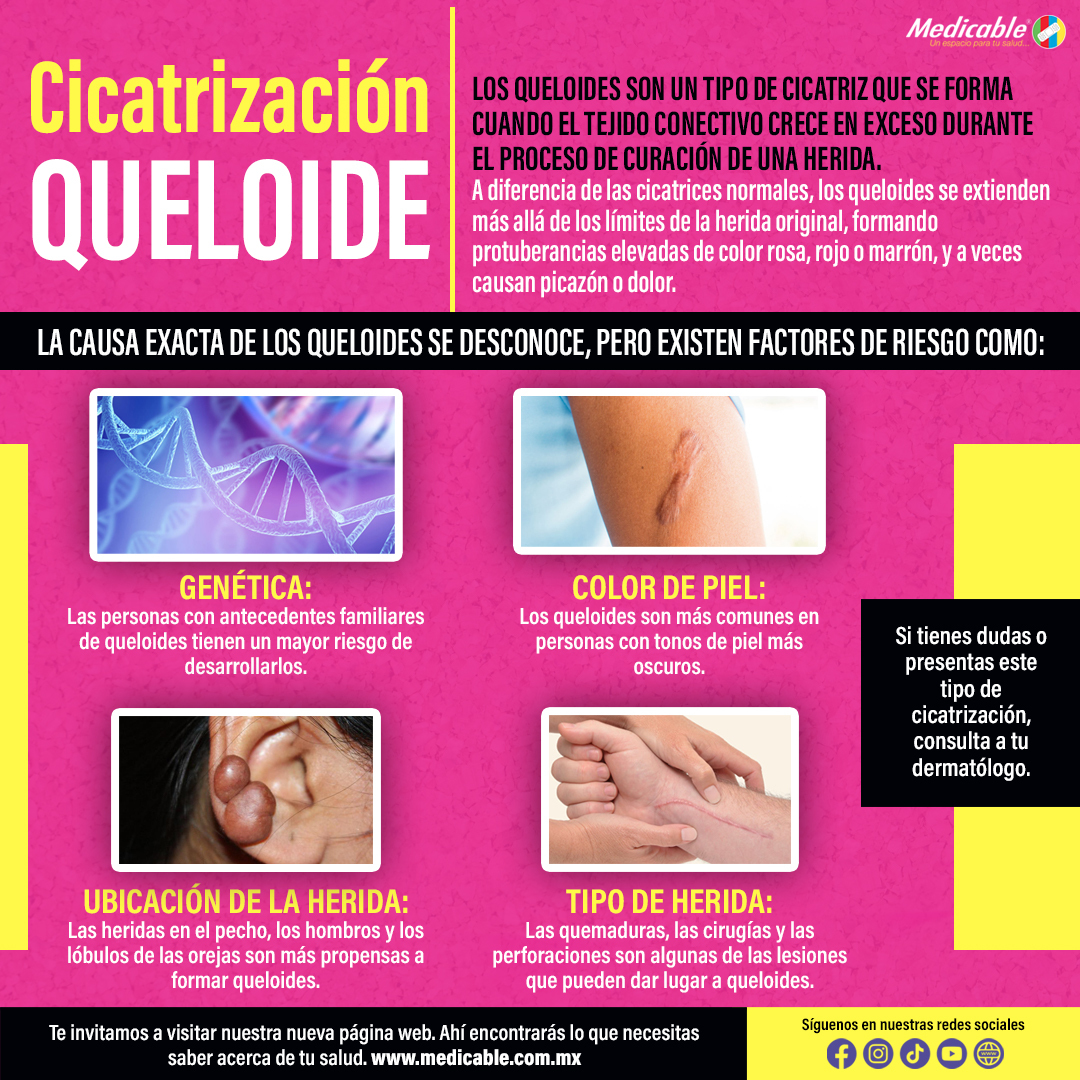 Cicatrización Queloide