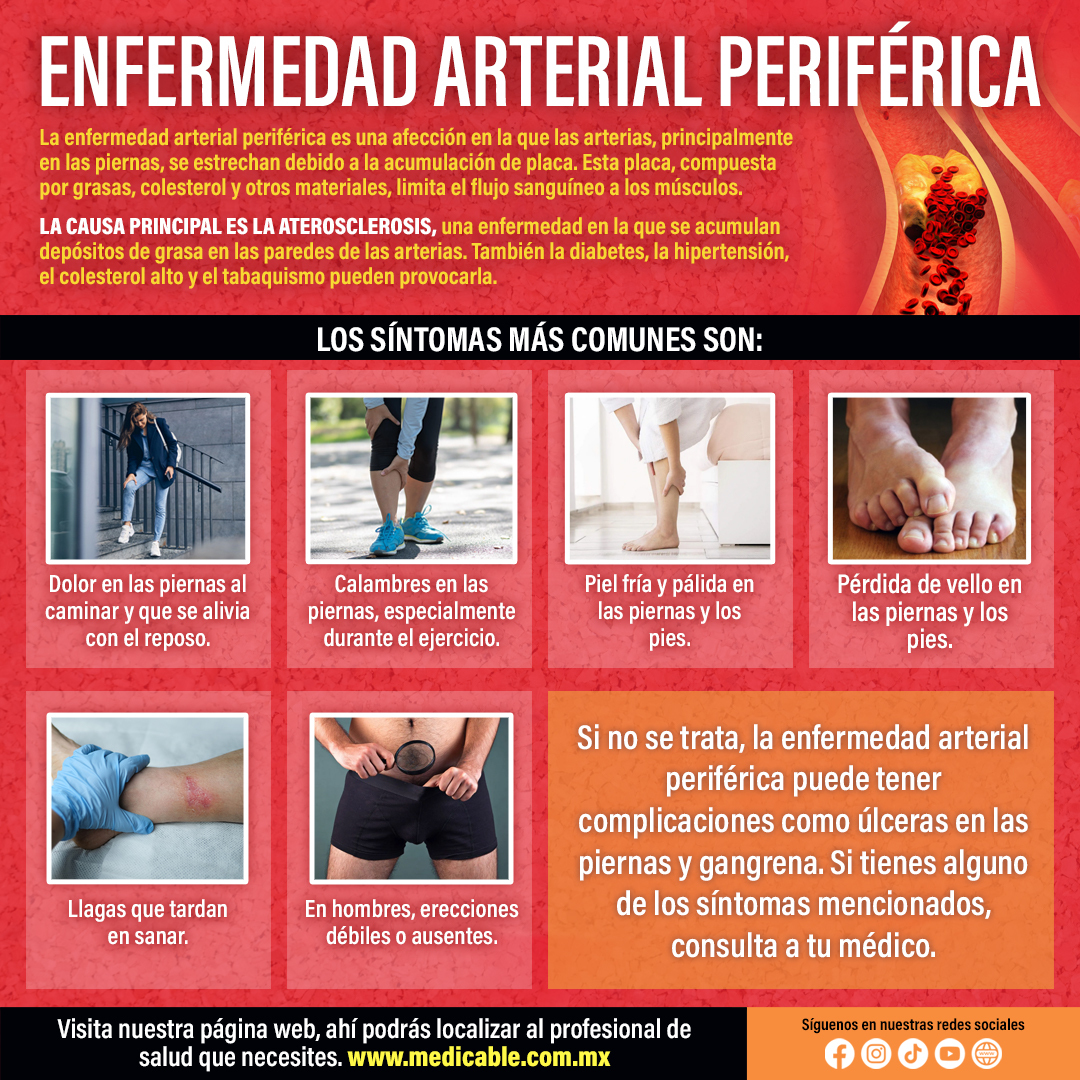 Enfermedad Arterial Periférica.
