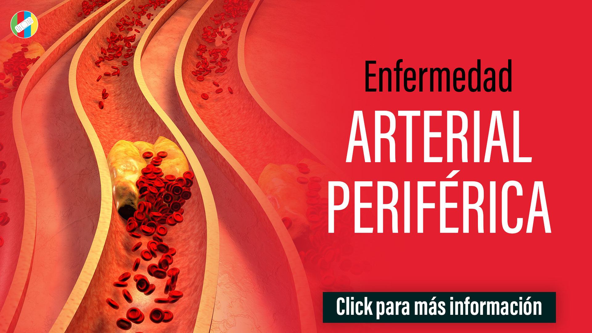 Enfermedad Arterial Periférica.
