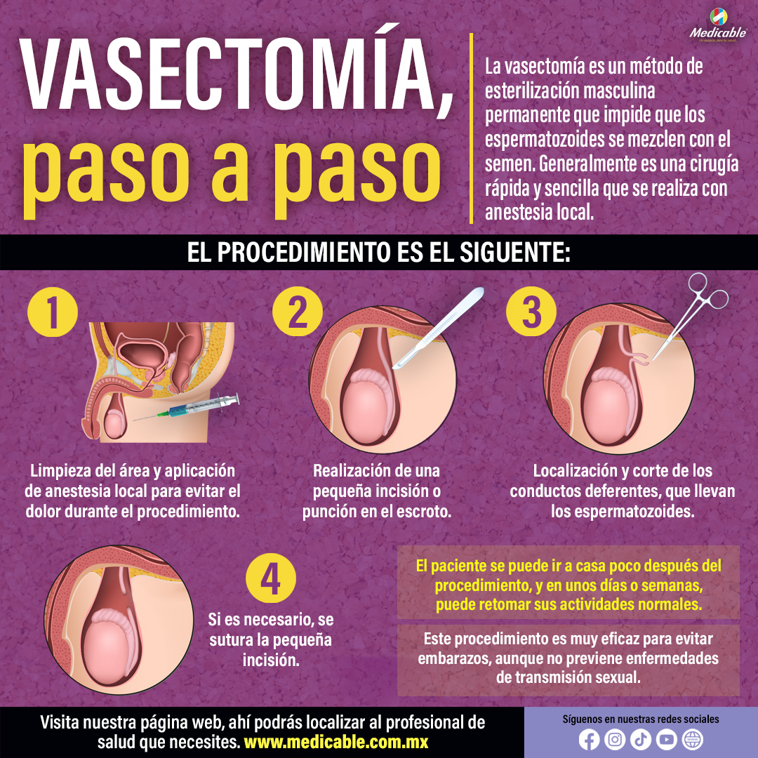 Vasectomía, paso a paso.