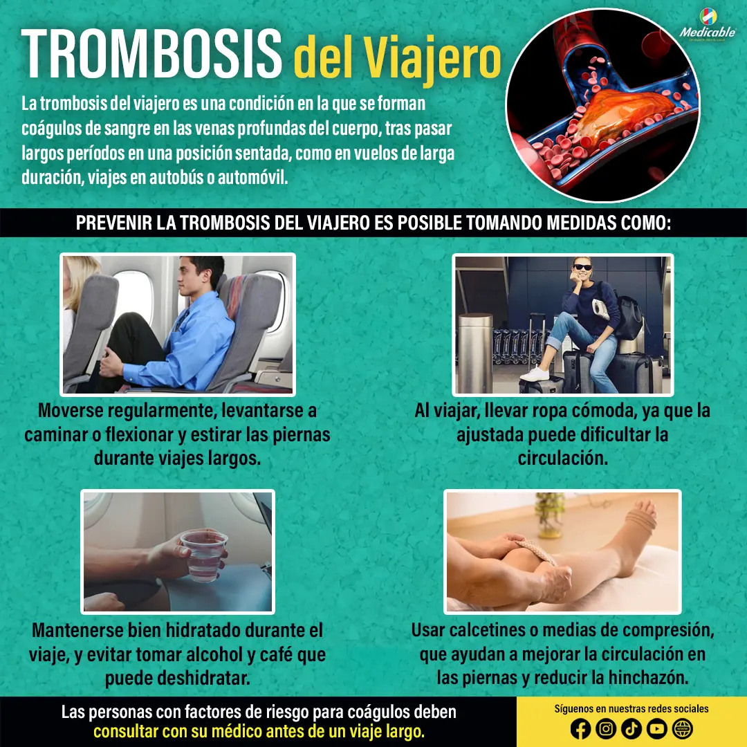 Trombosis del viajero.