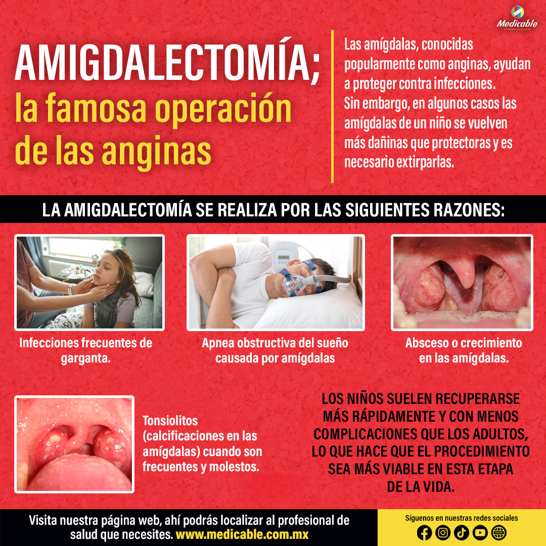 Amigdalectomía, la famosa operación de las anginas. 