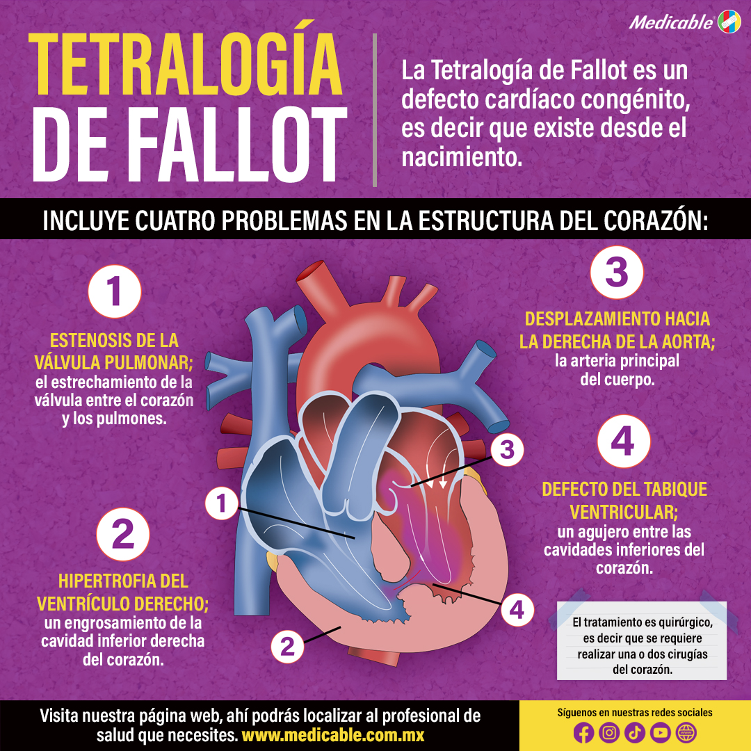 Tetralogía de Fallot.