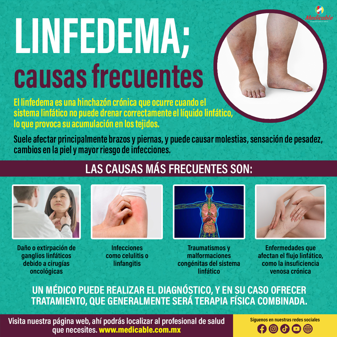 Linfedema, causas frecuentes.
