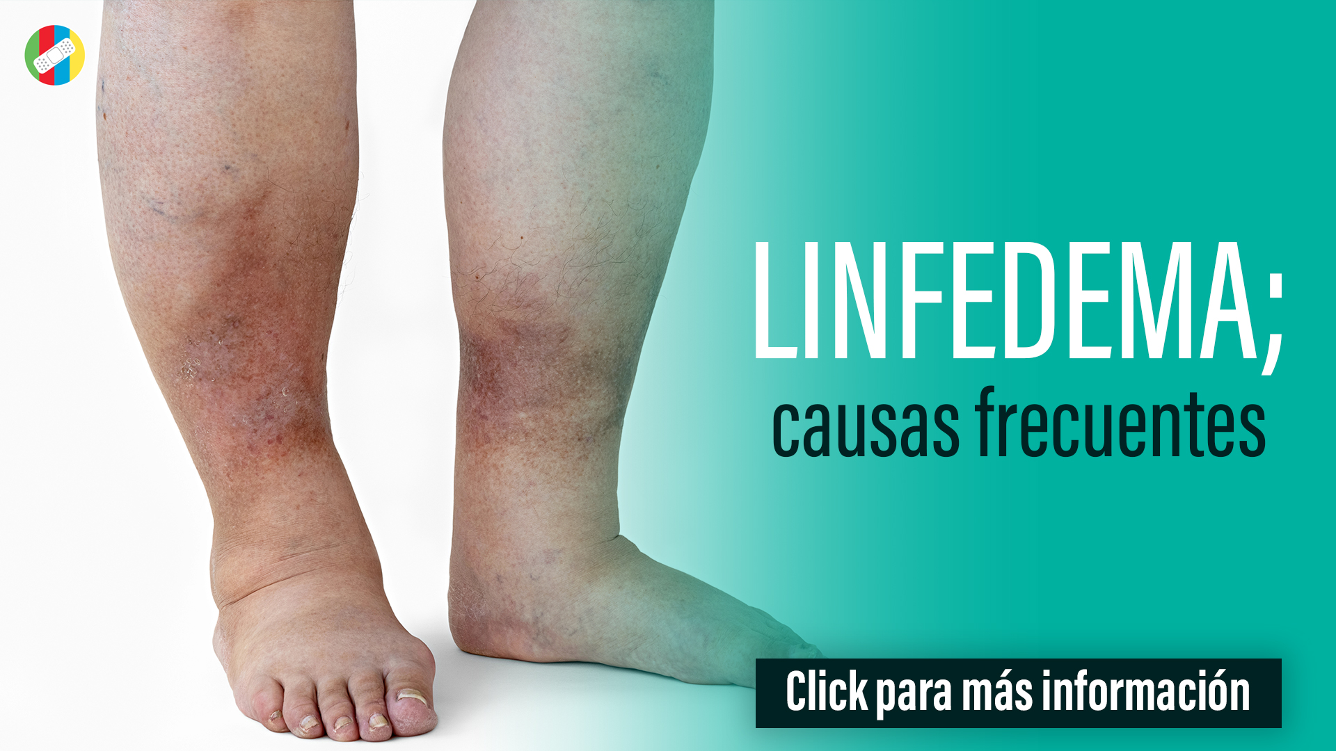 Linfedema, causas frecuentes.