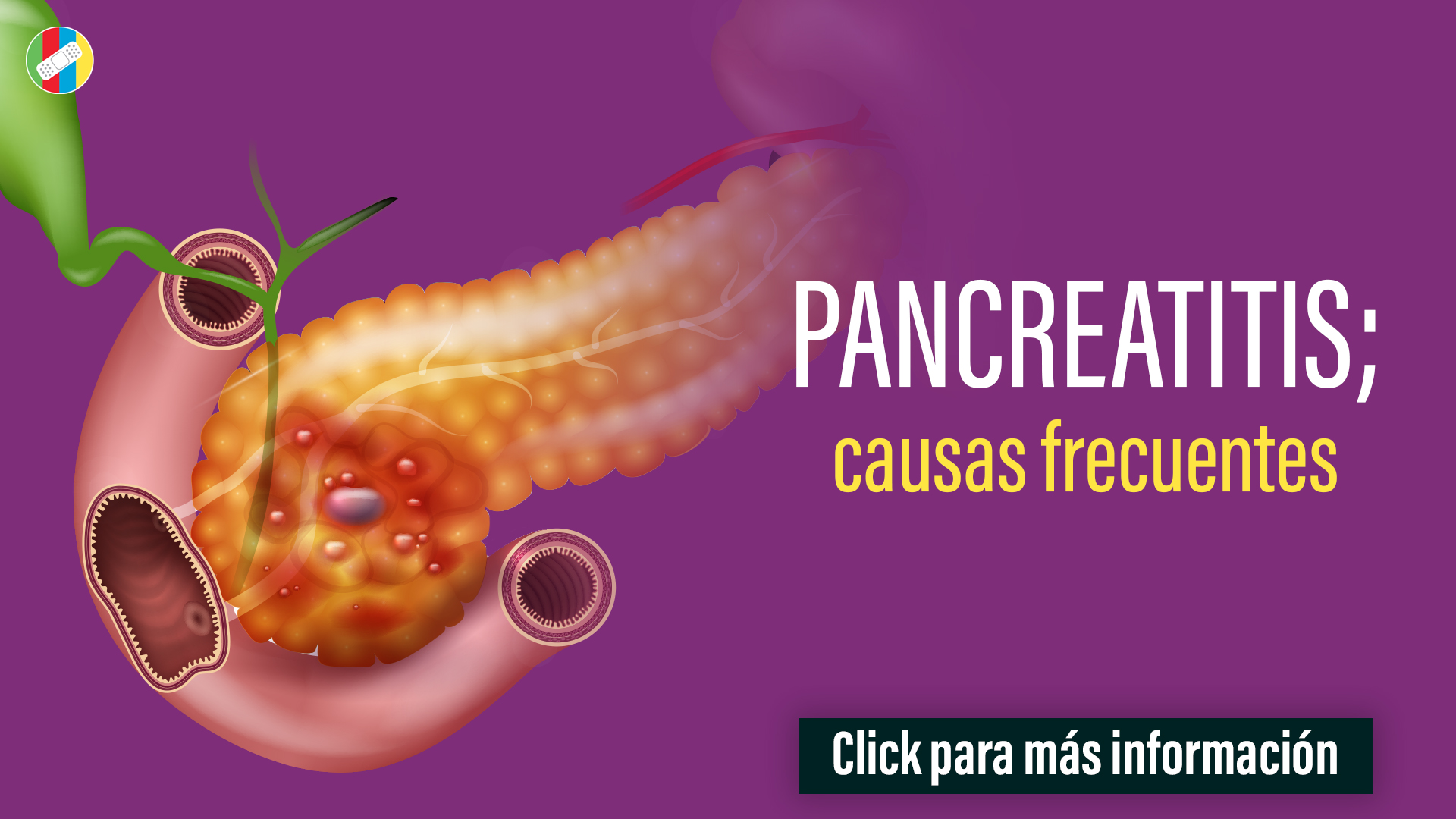 Pancreatitis, causas frecuentes.