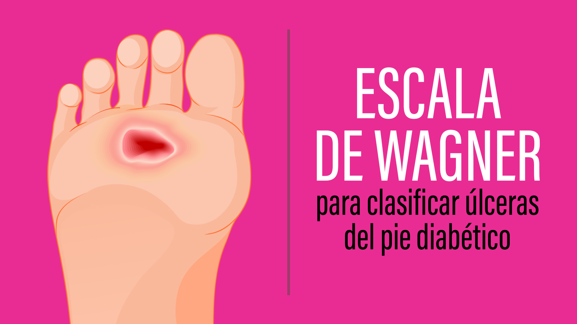 Escala de Wagner para clasificar úlceras el pie diabético.