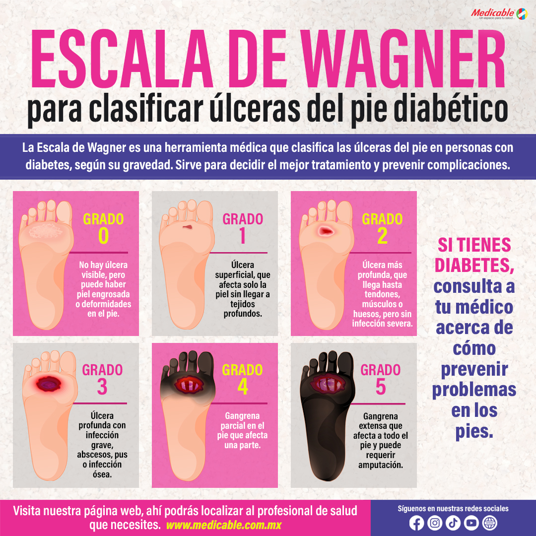 Escala de Wagner para clasificar úlceras el pie diabético.