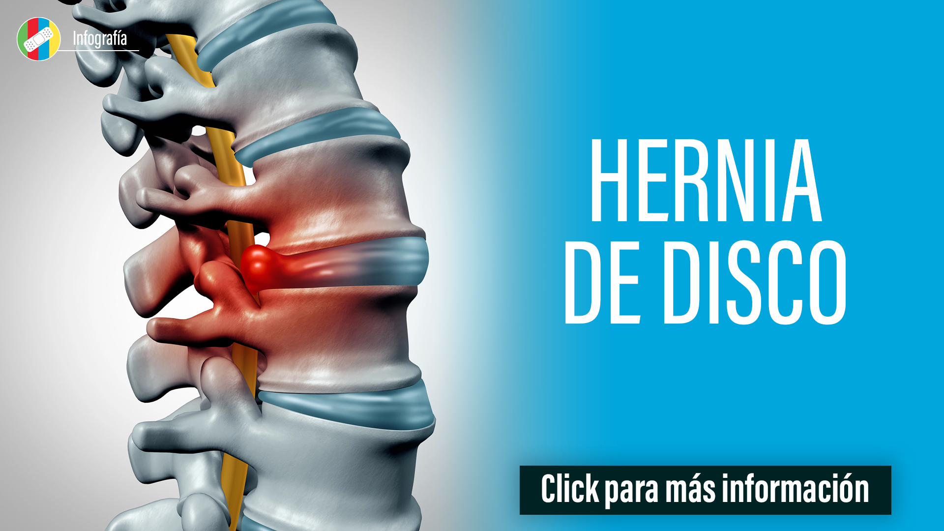 Hernia de disco.
