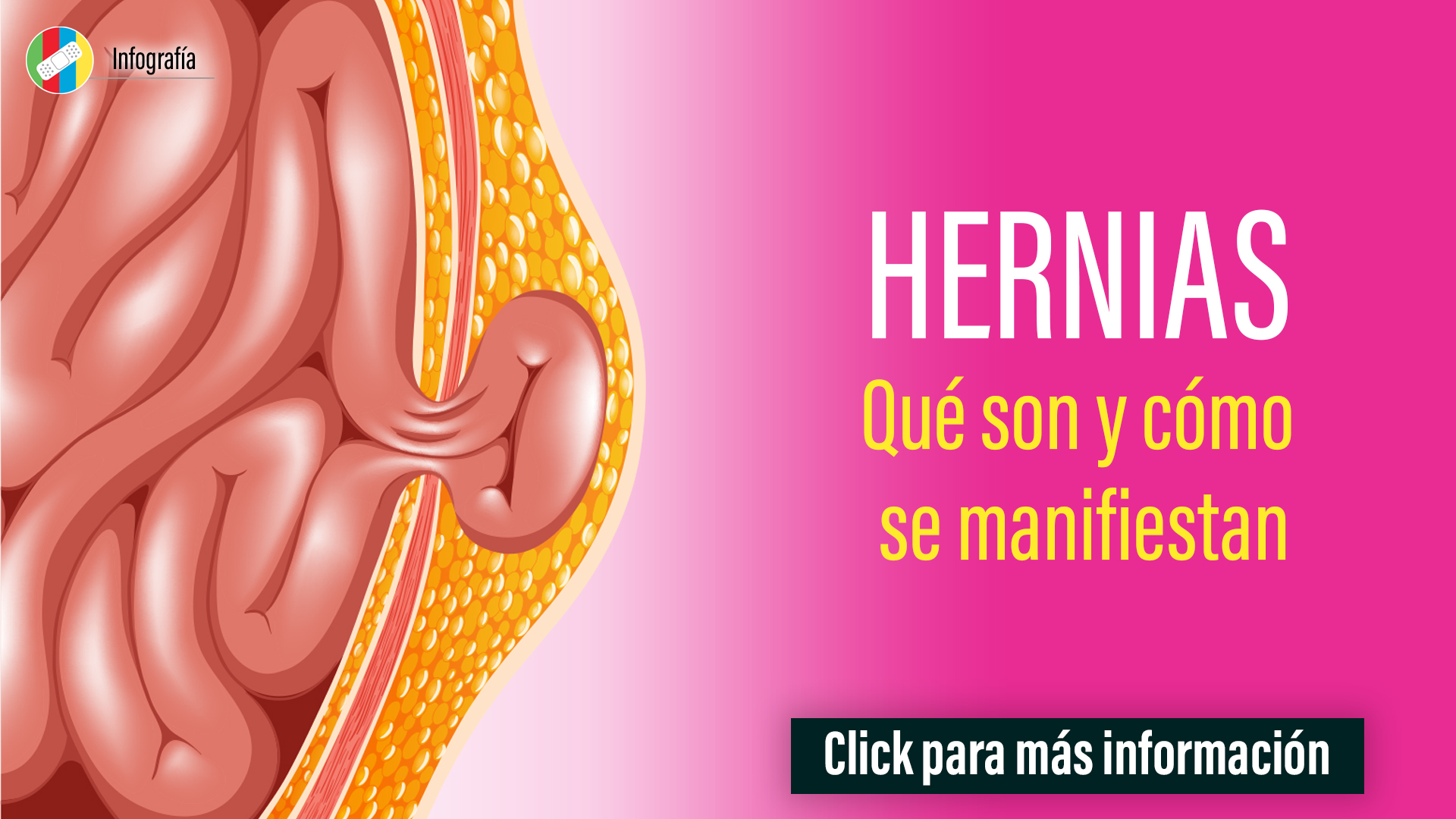 Hernias