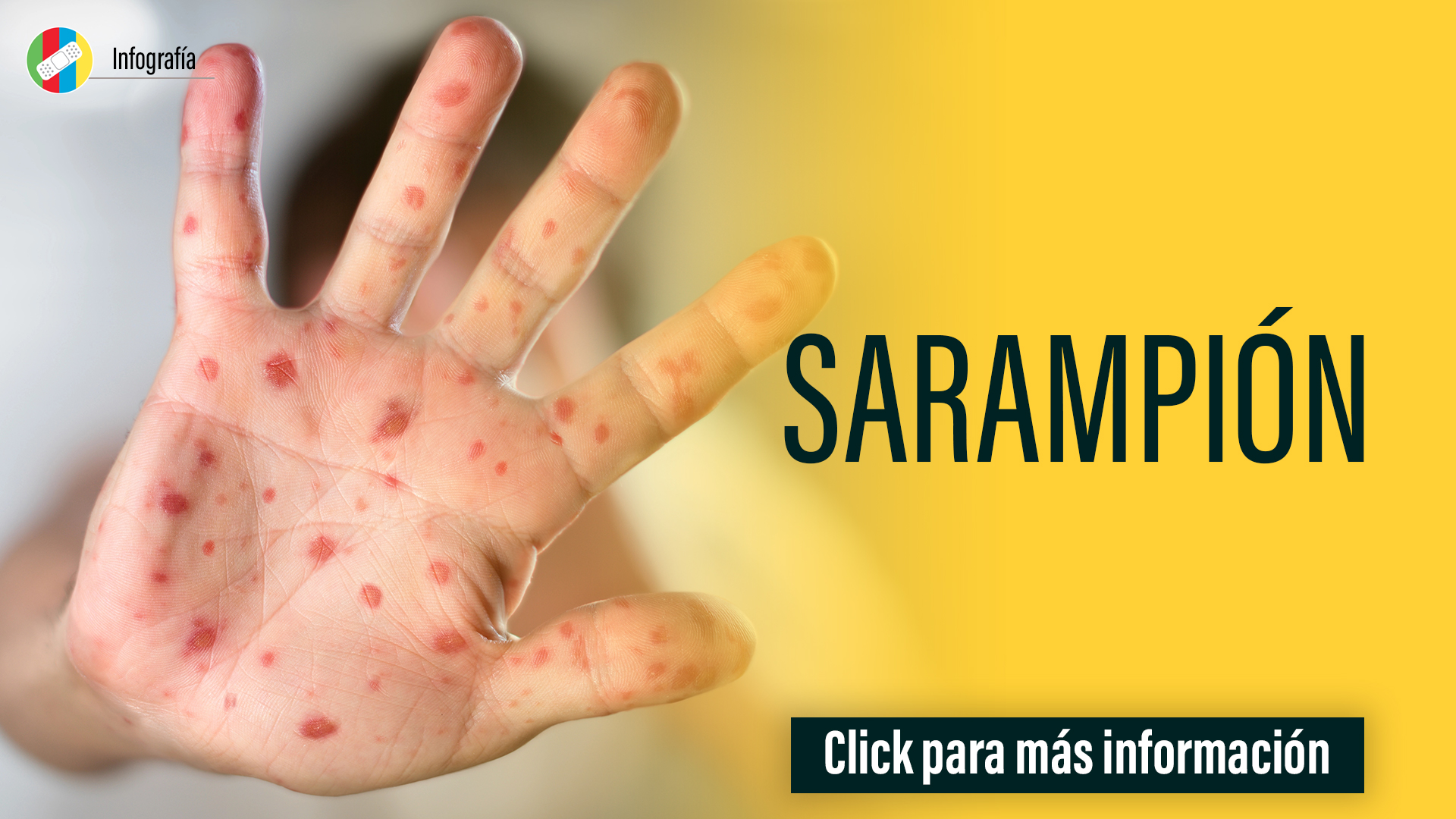 Sarampión