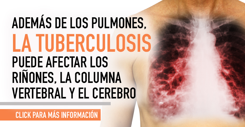 Tuberculosis